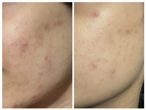 MandelAC Serum